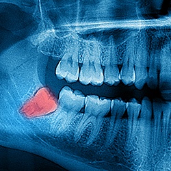 periodontal-therapy-6